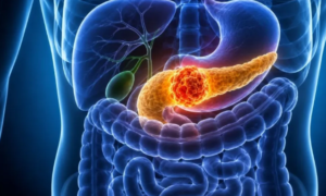 APRUEBAN NUEVO MEDICAMENTO PARA TRATAR EL CÁNCER DE PÁNCREAS Y YA ESTÁ DISPONIBLE PARA SU USO